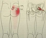 Stiff Shoulder Caused by Hip Problem