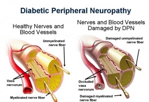 DiabeticNeuropathy