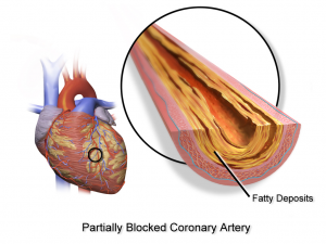 Blausen_0257_CoronaryArtery_Plaque