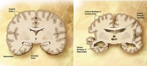 Alzheimer's_disease_brain_comparison