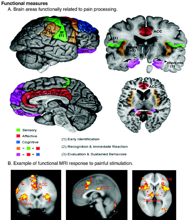 640px-Schematic_of_cortical_areas_involved_with_pain_processing_and_fMRI