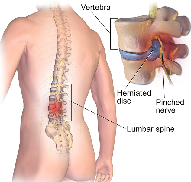 herniated disc and acupuncture