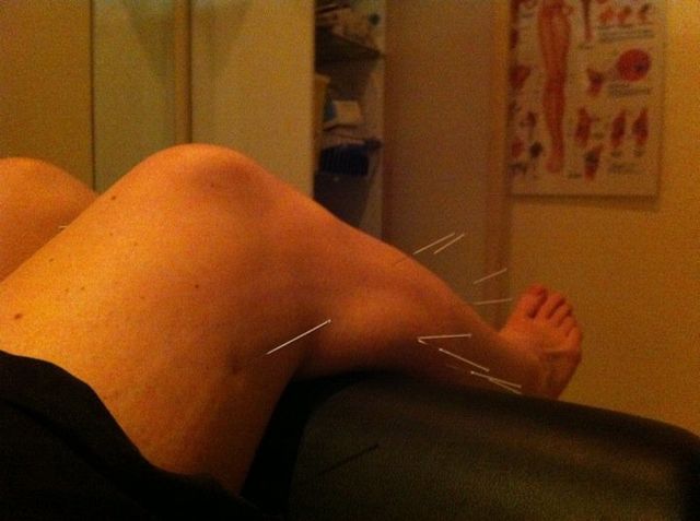 knee surgery and acupuncture