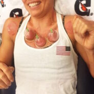 Olympic Athletes’ Performance Enhanced by Cupping Therapy