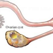 Polycystic Ovarian Syndrome Treated by Acupuncture