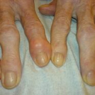 Acupuncture Reduces Arthritis Pain, Increases Mobility