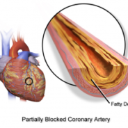 Acupuncture For Coronary Heart Disease