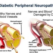 Diabetic Neuropathy and Acupuncture