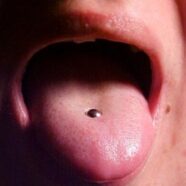 Stomach Pain Caused by Tongue Piercings
