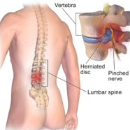 Lumbar Disc Herniation Pain Reduction