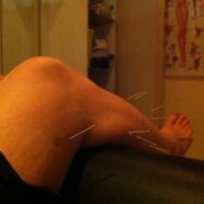 Pain Relief After Knee Surgery
